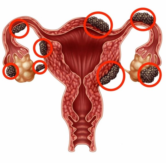 Ενδομητρίωση