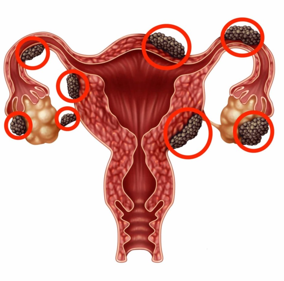 Ενδομητρίωση