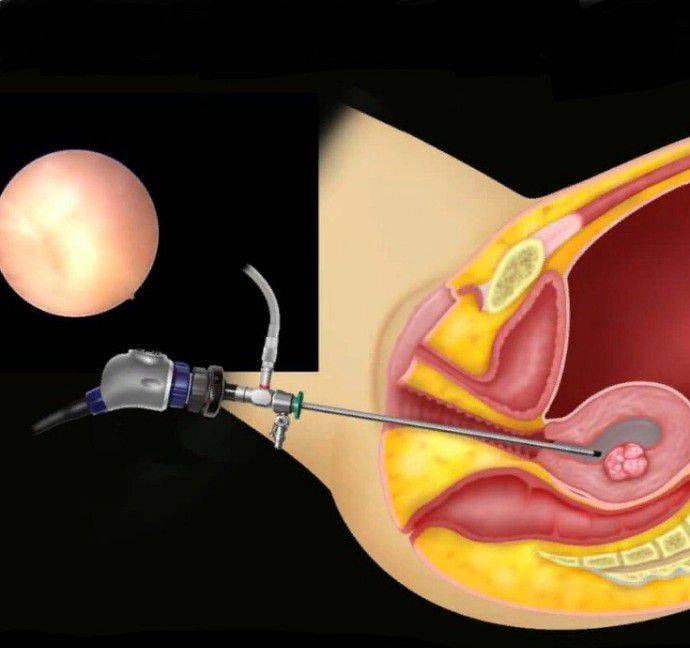 Υστεροσκόπηση
