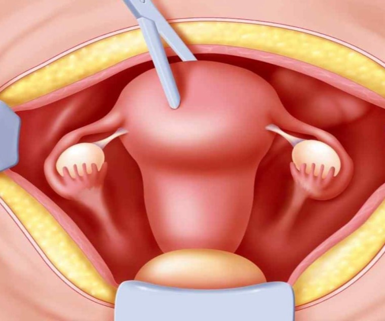 Υστερεκτομή