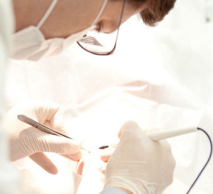 Αφαίρεση κονδυλωμάτων με laser