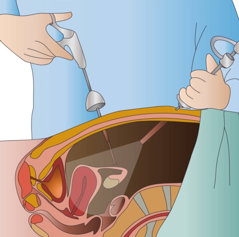 Λαπαροσκόπηση