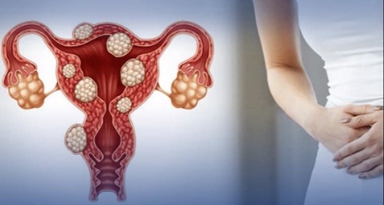 Τα ινομυώματα