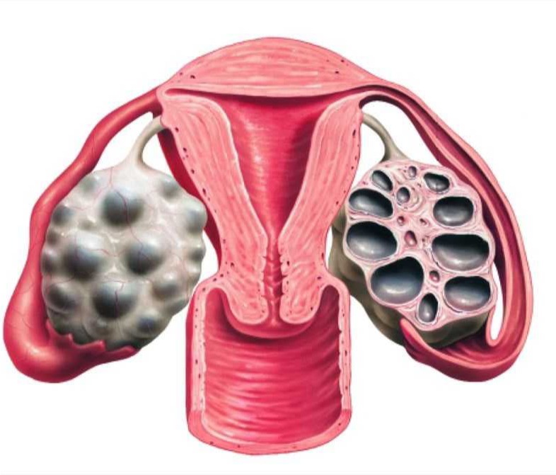 Πολυκυστικές Ωοθήκες