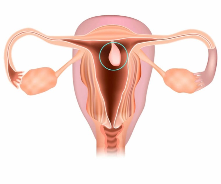 Πολύποδες Μήτρας