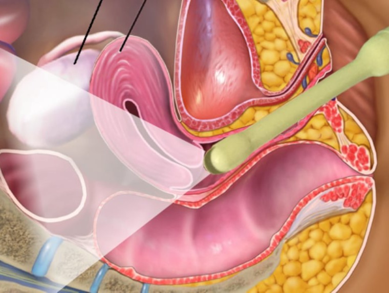 Υπερηχογραφικός κολπικός έλεγχος μήτρας και ωοθηκών