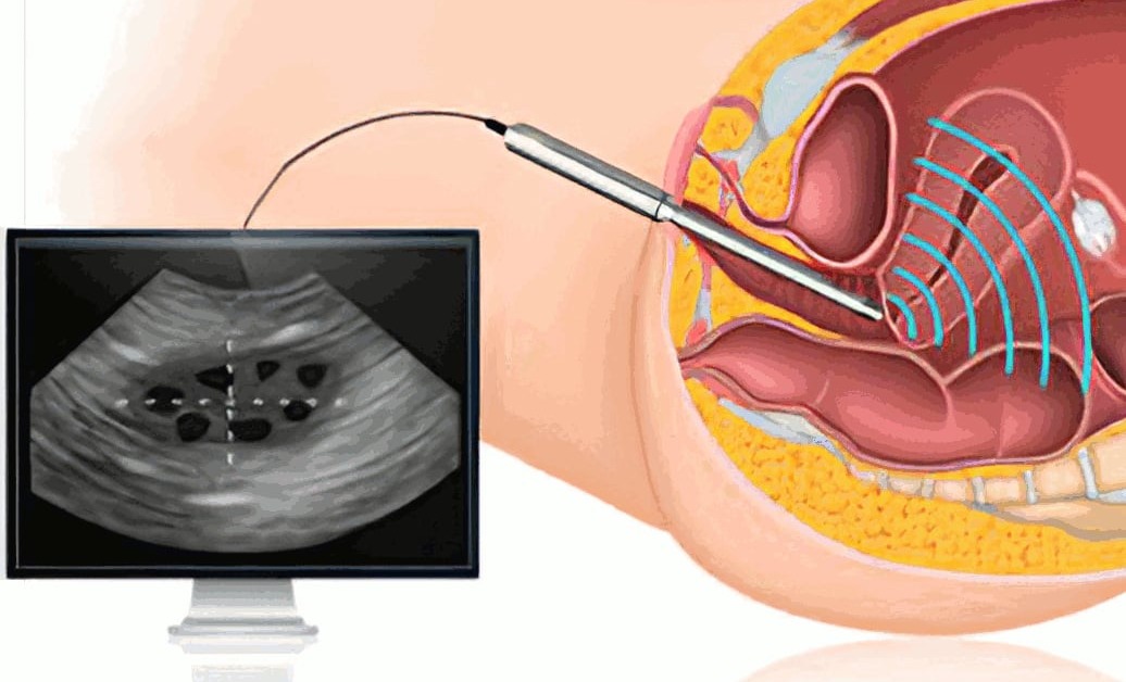 Διακολπικός υπέρηχος μήτρας ωοθηκών